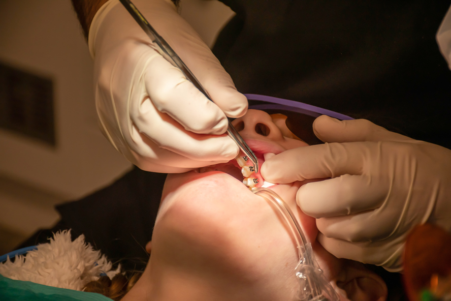 dental-braces-are-put-on-teeth-orthodontic-treatment