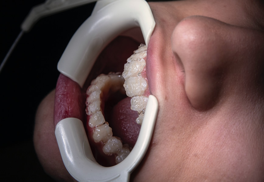 cosmetic denal treatment in care and cure dental clinic at dombivli and palava city