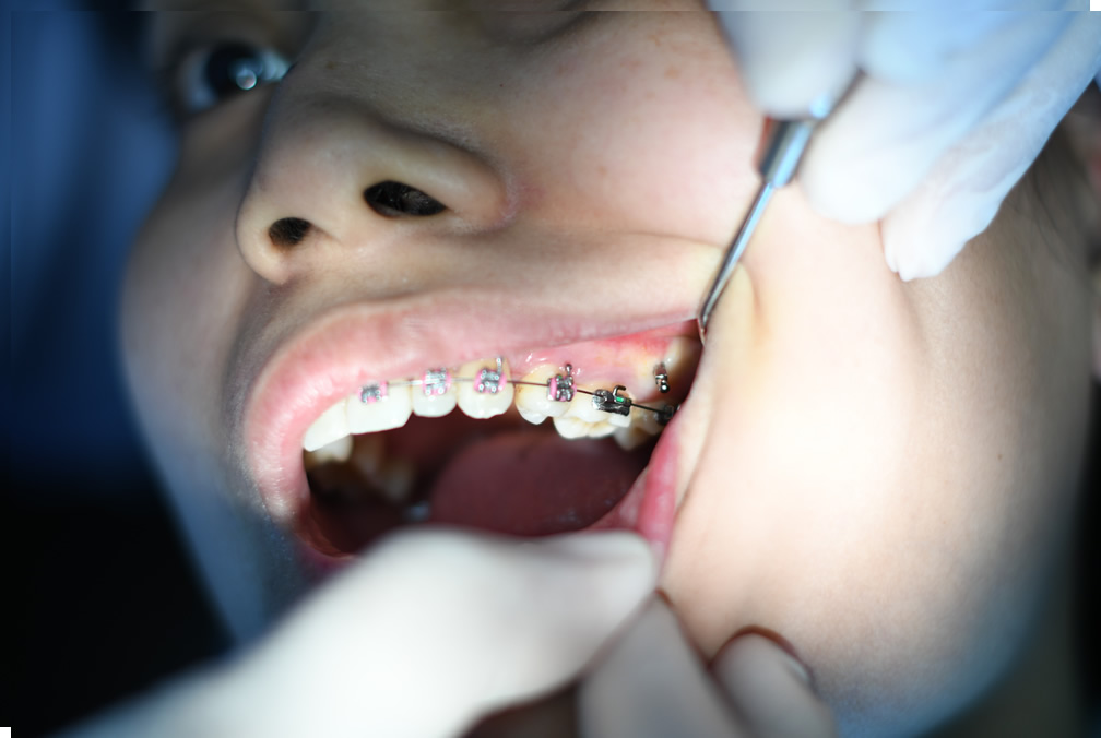 Best Braces and Orthodontic Treatments dental clinic dr tejal thorve in dombivli mumbai